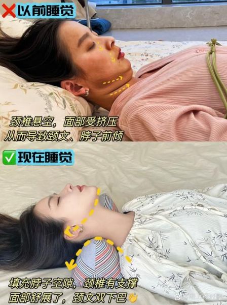 双鱼颈是什么症状_双鱼颈怎么矫正